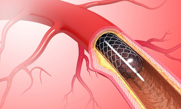 Peripheral Artery Disease Peripheral Artery Disease